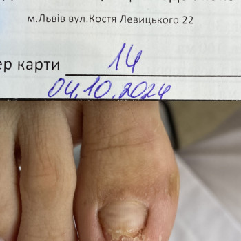 Протезування нігтьової пластини
                    Подолог Галина Львів