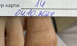 Протезування нігтьової пластини Подолог Галина Львов