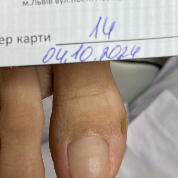 Протезування нігтьової пластини
                    Подолог Галина Львів