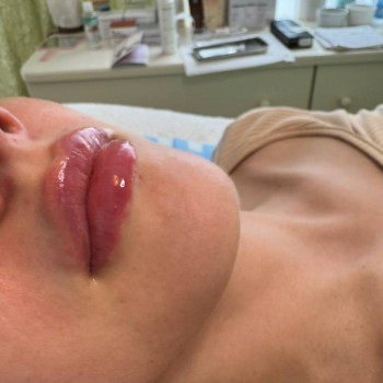 контурная пластика губ
увеличение губ
аугментация губ