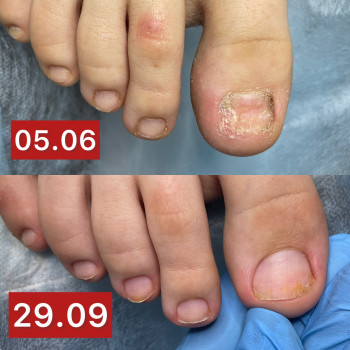 Оніхомікоз