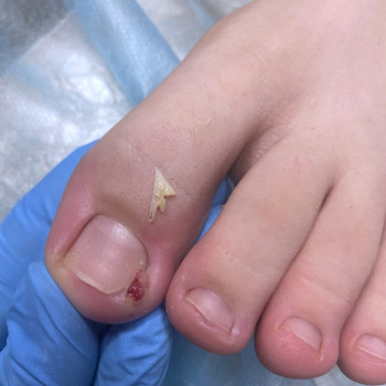 Обробка врослого нігтя