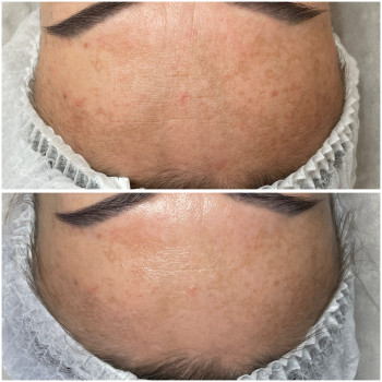 Освітлюватьна терапія «Стоп пігмент»
1 процедура