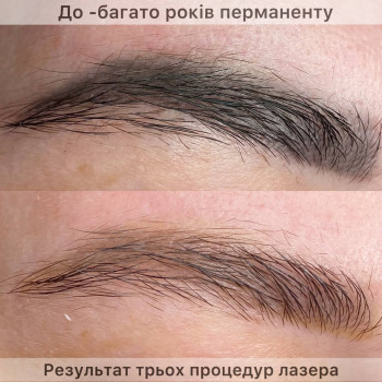 Видалення перманентного макіяжу
                    Майстер перманентного макіяжу Татьяна Вінниця