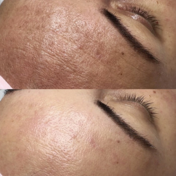 Пілінг BioRePeel
                    Косметологічний центр Естетік Лав Львів