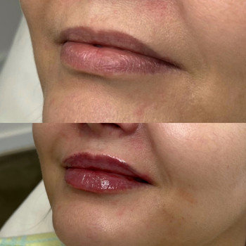 Контурна пластика (губи/скули/підборіддя/нижня третина/бланшинг (заповнення зморшок))
                    Косметологічний центр Естетік Лав Львів