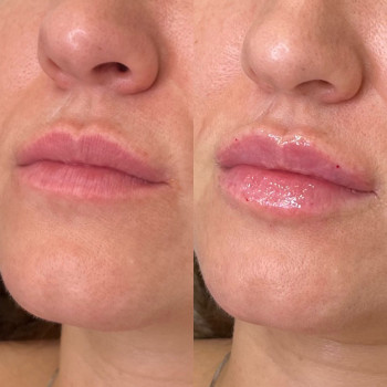 Контурна пластика (губи/скули/підборіддя/нижня третина/бланшинг (заповнення зморшок))
                    Косметологічний центр Естетік Лав Львів