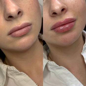 Контурна пластика (губи/скули/підборіддя/нижня третина/бланшинг (заповнення зморшок))
                    Косметологічний центр Естетік Лав Львів