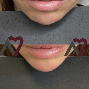 Контурна пластика (губи/скули/підборіддя/нижня третина/бланшинг (заповнення зморшок))
                    Косметологічний центр Естетік Лав Львів