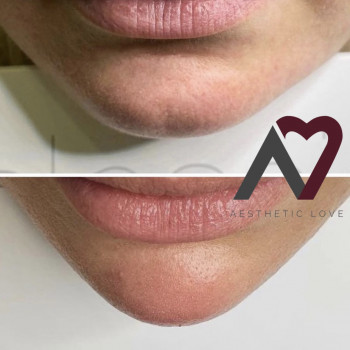 Контурна пластика (губи/скули/підборіддя/нижня третина/бланшинг (заповнення зморшок))
                    Косметологічний центр Естетік Лав Львів