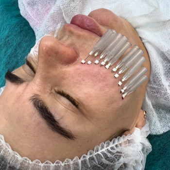 Пропрацьована зона носо щічноі зони для усунення провалу та укріплення даноі зони