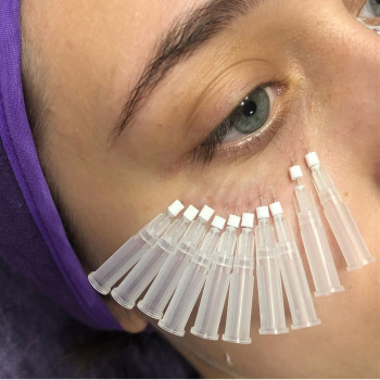 Колагеностимуляція зони під очима 
мезонитками #