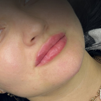 Контурна пластика губ
                    Врач-косметолог Ирина Краматорск