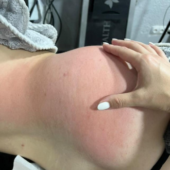 Ручна ліпосакція
                    Массажист Любовь Одесса