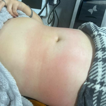 Ручна ліпосакція
                    Массажист Любовь Одесса