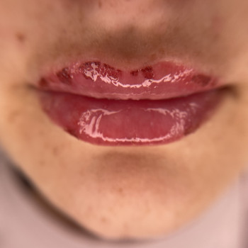 Губи у процесі загоєння