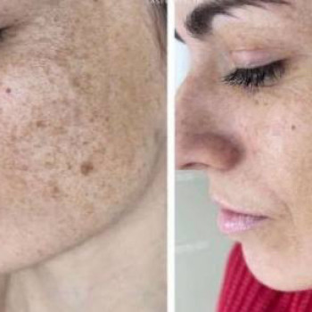 Фотоомолодження/видалення пігментації/лікування судин та акне
                    Дерматолог косметолог Ірина Винница