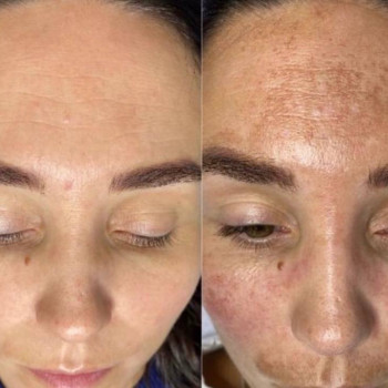 Фотоомолодження/видалення пігментації/лікування судин та акне
                    Дерматолог косметолог Ірина Винница