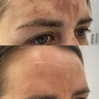 Фотоомолодження/видалення пігментації/лікування судин та акне
                    Дерматолог косметолог Ірина Винница