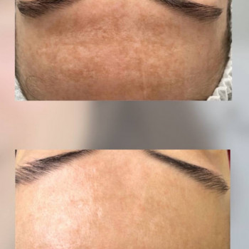 Фотоомолодження/видалення пігментації/лікування судин та акне
                    Дерматолог косметолог Ірина Винница