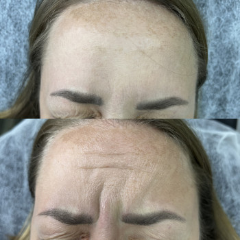 Ботокс
                    Врач-косметолог Ирина Краматорск