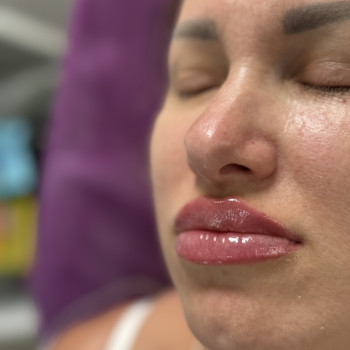 Збільшення губ
                    Косметолог-ін'єкціоніст Анна Чернівці