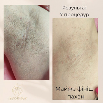  #електроепіляція #електроепіляціябікіні #електроепіляціяобличчя #електроепіляціяноги #епіляція