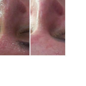 Чистка обличчя + Альгінатна маска у подарунок!
                    Косметолог Лілія Винница