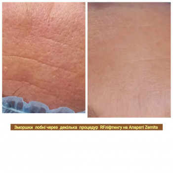 RF ліфтинг на апараті Zemits
                    Косметолог Лілія Винница