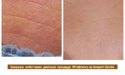 RF ліфтинг на апараті Zemits Косметолог Лілія Вінниця