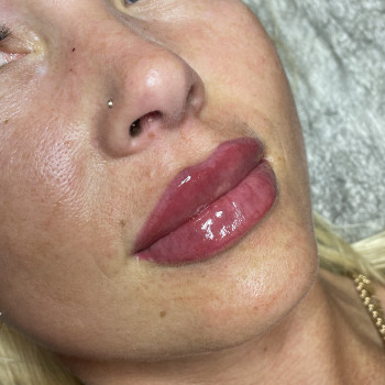 Збільшення губ 2мл