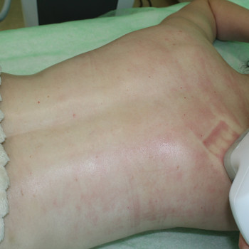 Антицелюлітний Vela Shape масаж.
                    Медичний центр Микамед Харків