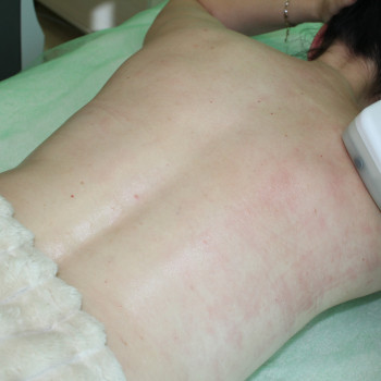 Антицелюлітний Vela Shape масаж.
                    Медичний центр Микамед Харків