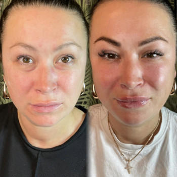   пластика Fullface
  борозда
  пластика підборіддя
  пластика скул