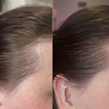 Жіночі залисини, три сеанси і все приховано