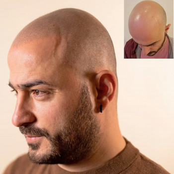 Імітування раннього облисіння