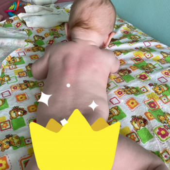 Дитина 2,5 міс не тримала голову, низький загальний тонус мʼязів. На фото після курсу тримає голову,...