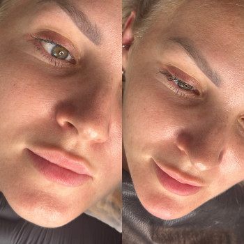 Контурна пластика підборіддя