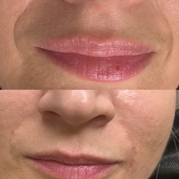 Заповнення носогубнтї складки