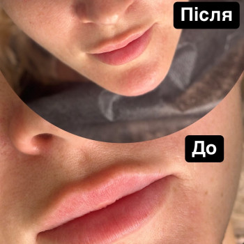 Коньтурна пластика підборіддя