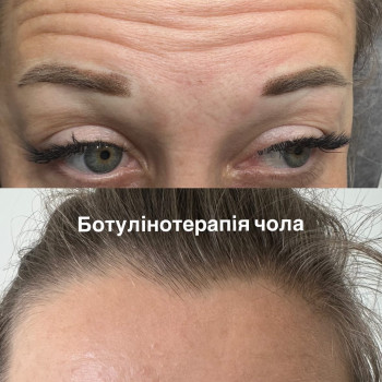 Ботулінотерапія
                    Косметолог Уляна Львів