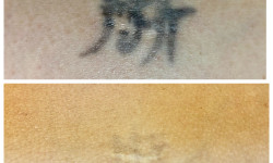 Видалення тату/татуажу Мастер депиляции Татьяна Днепр