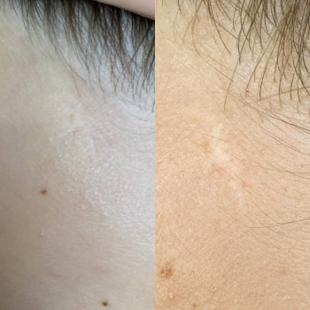 Загоєний після однієї процедури мікронідлінг/до
 