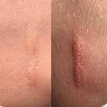 Загоєний/до
 