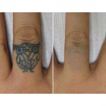 Видалення татуажу
                    Косметологічний центр Medlas Київ