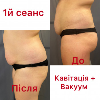 Після першого сеансу апаратної корекції «Тіло мрії» Стандарт