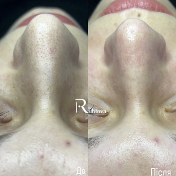 Чистка обличчя (комбінована)
                    Врач-косметолог Ксенія Ужгород