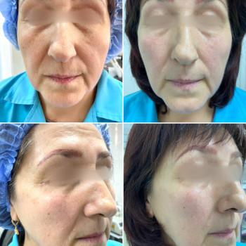 Контурна пластика середньої третини обличчя