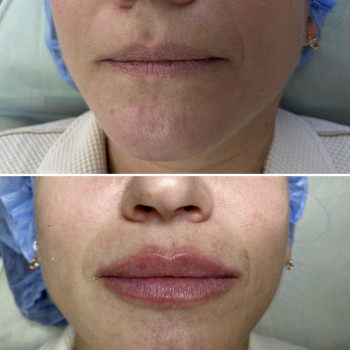 Контурна пластика губ