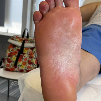 Обробка тріщин
                    Центры подологии Твоя стопа Львов